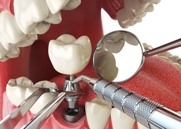 Continuing education (CE) courses for dental implants