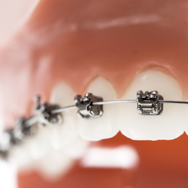 orthodontic dental ce
